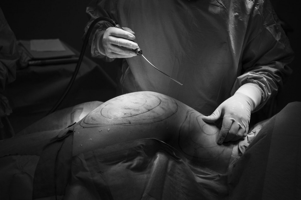 Las piernas pintadas de una paciente que se somete a una liposucción marcan las lineas en las que el cirujana doble incidir para reducir la acumulación de grasa. Para saber más sobre esta operación pulsa sobre la imagen. © Pedro ARMESTRE-X